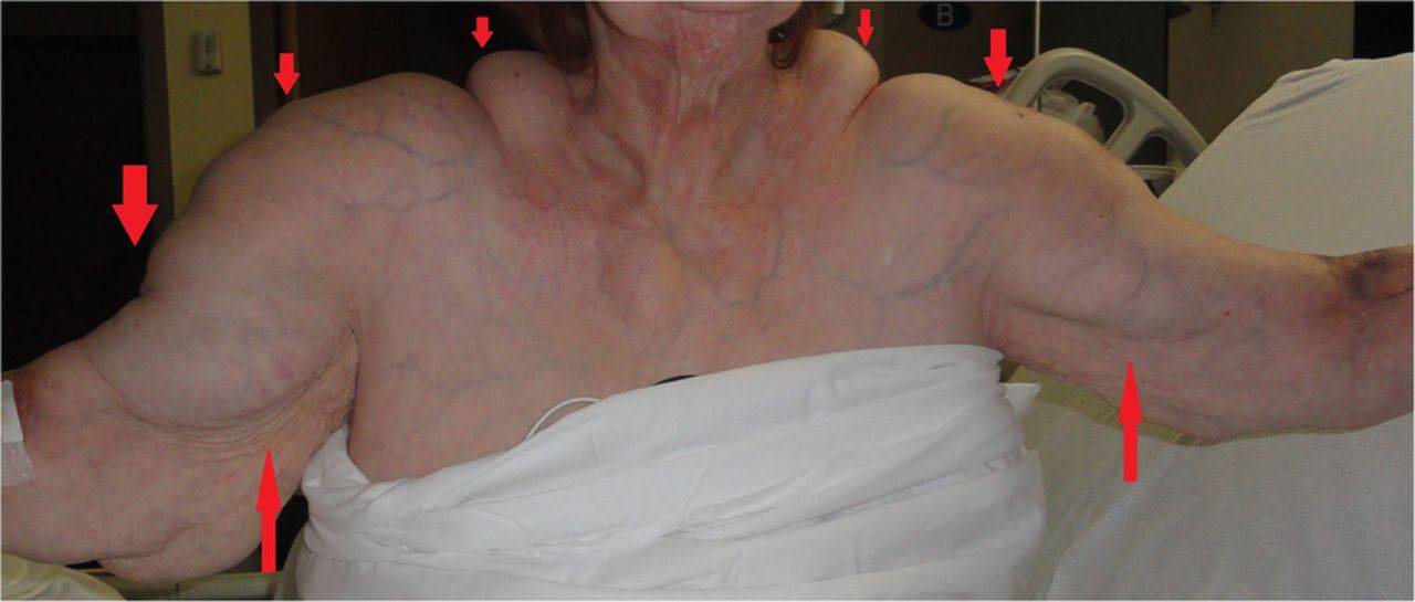 Evo što radi alkohol: Žena (64) je na leđima i vratu dobila grbe