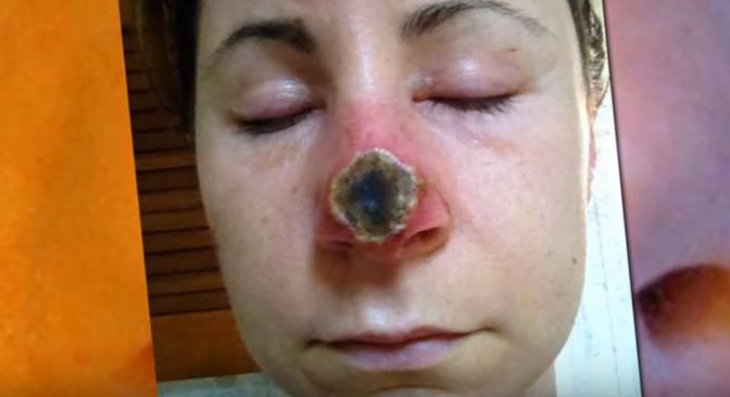 Mazala tumor crnim melemom pa joj otpalo gotovo pola  nosa
