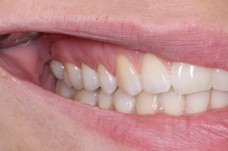 Osmijeh koji izgleda prirodno? Tajna je u preciznom planiranju i kvalitetnom materijalu