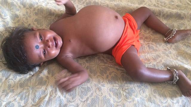 Parasitic Twin Removed From One-Year-Old Girl