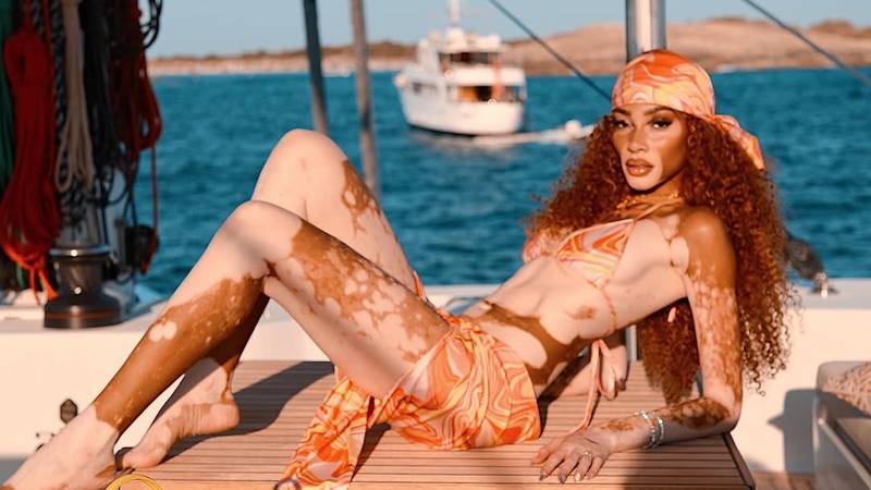 FOTO Rugali su joj se zbog bolesti, a danas je obožavaju zbog jedinstvenog izgleda