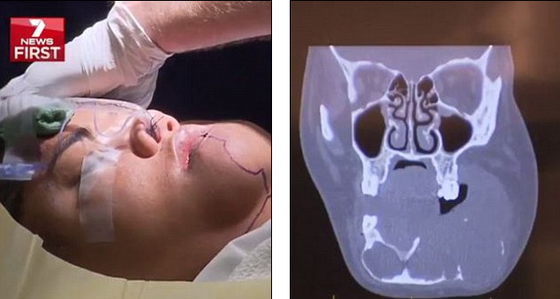 Djevojci (19)  tumor deformirao lice: Ugradili  su joj kost iz noge