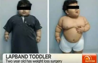Dvogodišnjak imao čak 33 kg: Spasili ga smanjenjem želuca