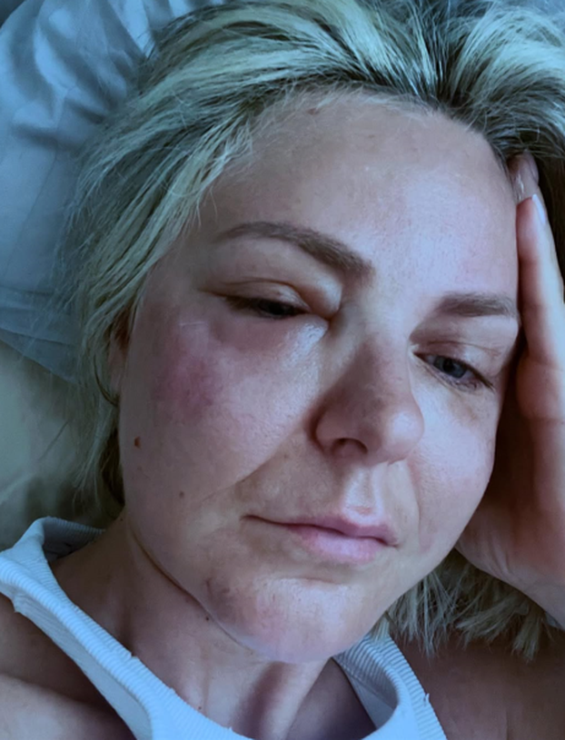 FOTO Ove slavne dame išle su pod nož: Neke su zablistale, drugima su zahvati uništili lice