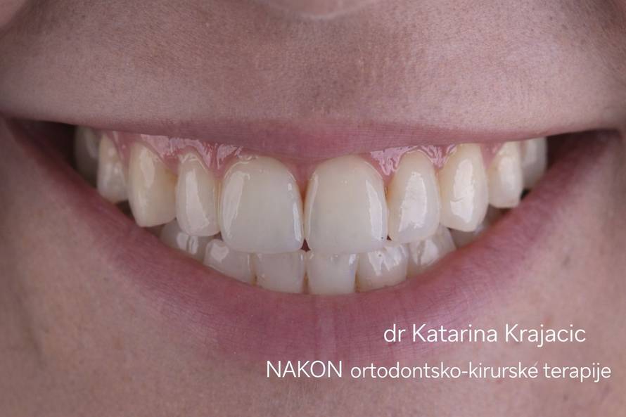 Ortodontsko-kirurška terapija odraslih - Evo što trebate znati