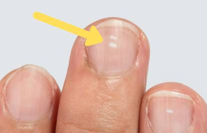Znate li zašto ponekad imate male bijele mrlje na noktima?
