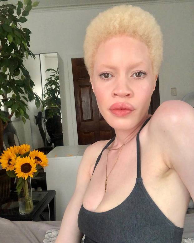 FOTO Afrikanka s albinizmom osvaja modnu industriju: 'Često privlačim znatiželjne poglede'