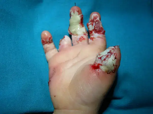 Evo zašto su zabranili petarde: Ovako izgledaju ruke djece koja su stradala od pirotehnike