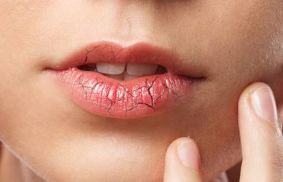Pet kućnih lijekova za ispucale usne: Djeluju bolje od balzama