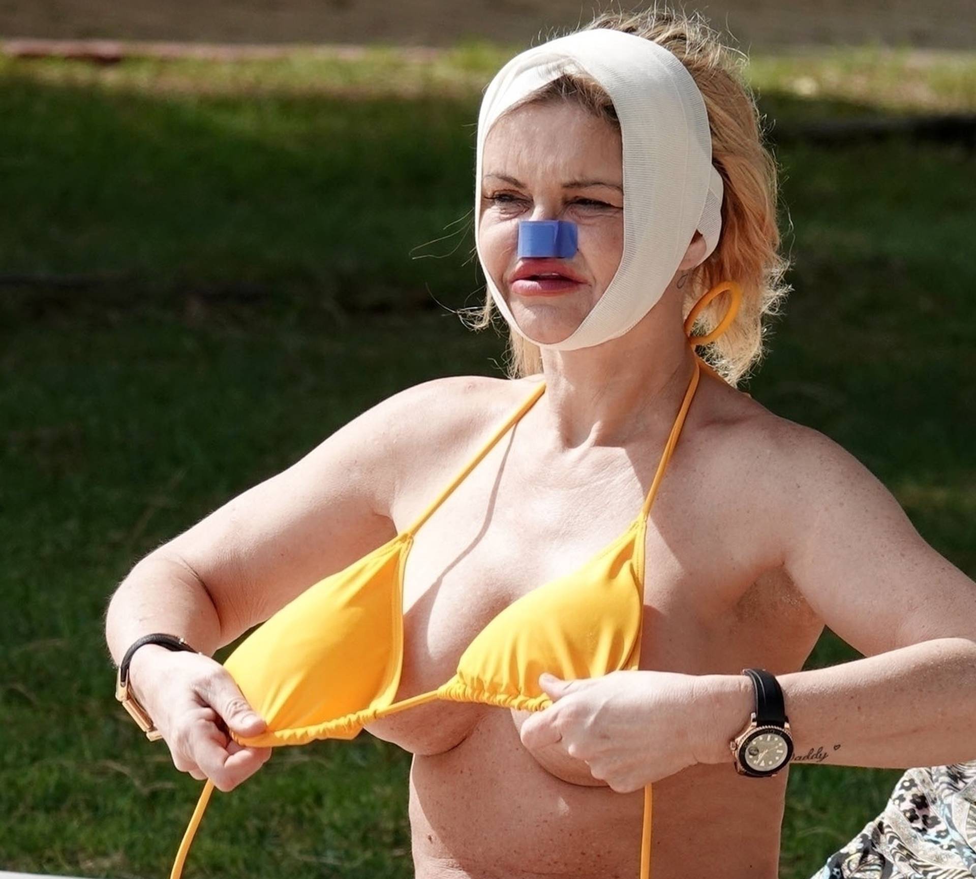 *PREMIUM-EXCLUSIVE* *MUST CALL FOR PRICING* Former Eastenders Actress Danniella Westbrook underwent life-changing surgery to rebuild her face as the star was sunbathing with bandages around her head and nose out in Turkey.