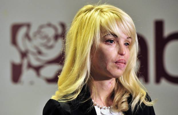 London: Djevojka koju je de?ko polio kiselinom aktivna u politici