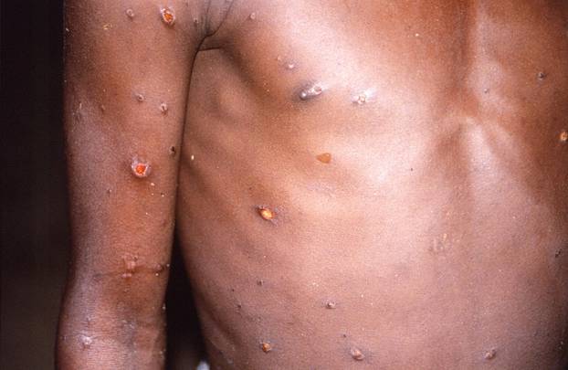 FILE PHOTO: A CDC image shows skin lesions on a monkeypox patient