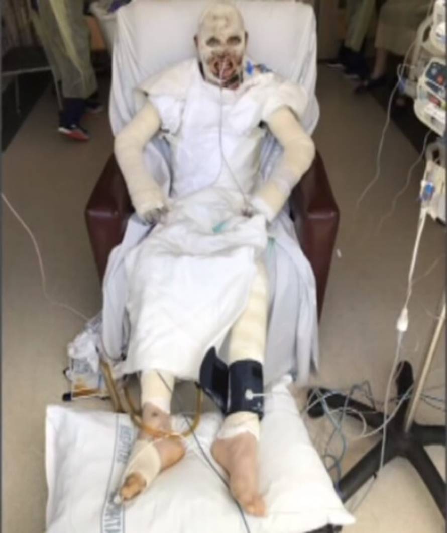 Preživio je erupciju vulkana, a sada uči kako ponovno hodati