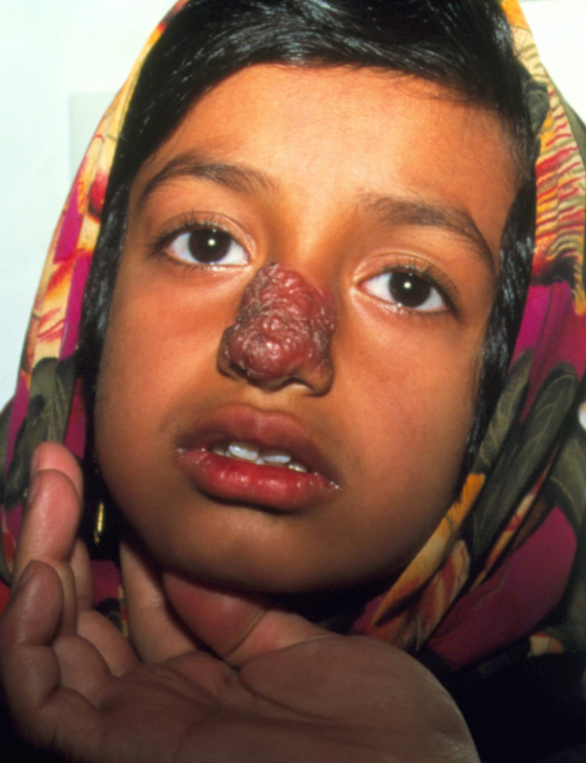Cutaneous leishmaniasis lesion on a girl's face