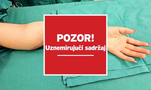 EKSKLUZIVNO Dijete stradalo na A3. Čudesnim zahvatom na Rebru spasili joj smrskanu ruku