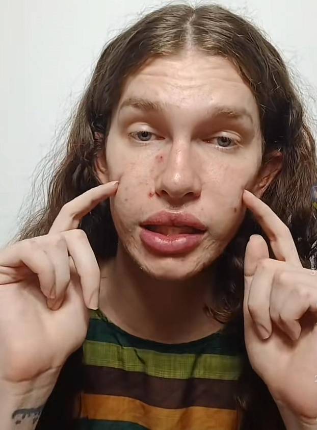 FOTO Htjela je biti žena mačka, a sad plače: Dala sam 7000 €, a fileri su me unakazili! Pomiču se