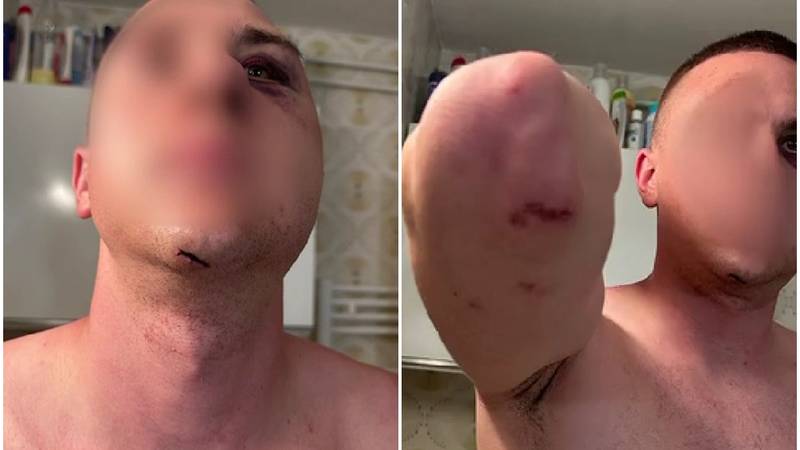 Brutalno pretukli Slovence u Medulinu. Još jednog napadača otkrili, za dvojicom se traga