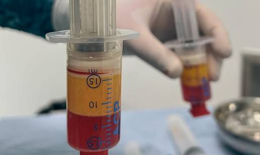 PRP u stomatologiji: Br&zcaron;i oporavak nakon zahvata desni