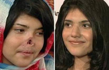 Dobila novi nos: Afganistanki Bibi (19) vratili osmijeh na lice 