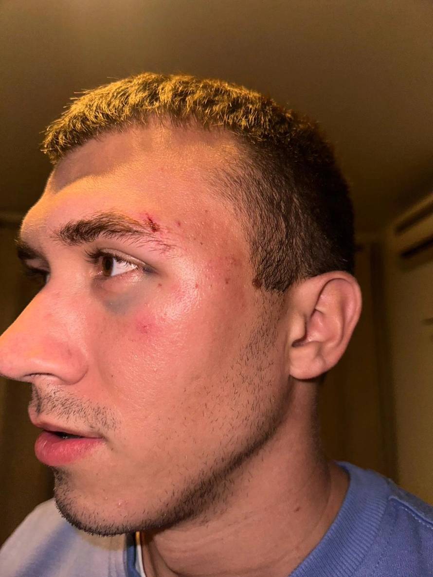 VIDEO Kaos u Orebiću: Šef kluba ugrizao suparnika za oko! Evo kako izgledaju napadnuti igrači