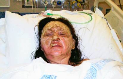 Upaljač joj ekslplodirao dok je vozila i zapalio joj lice i vrat