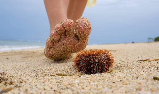 Što morate učiniti ako stanete na ježinca ili opeče vas meduza?