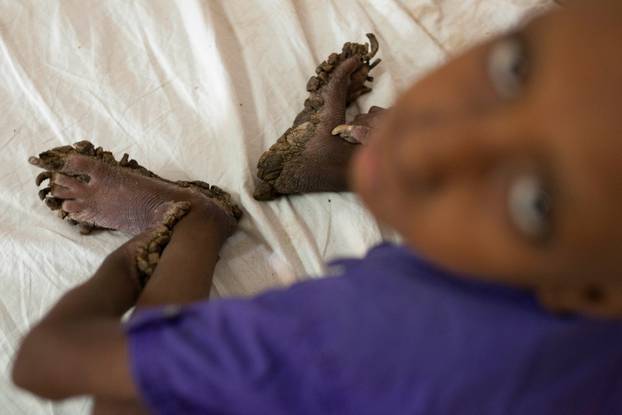 7-Year Old Boy With Tree-Man Illness In Bangladesh