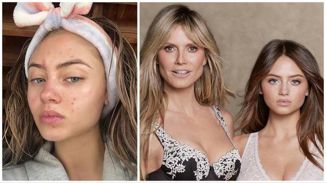 Lijepa kći Heidi Klum pokazala kako izgleda bez trunke šminke: 'Akne su sasvim normalne...'