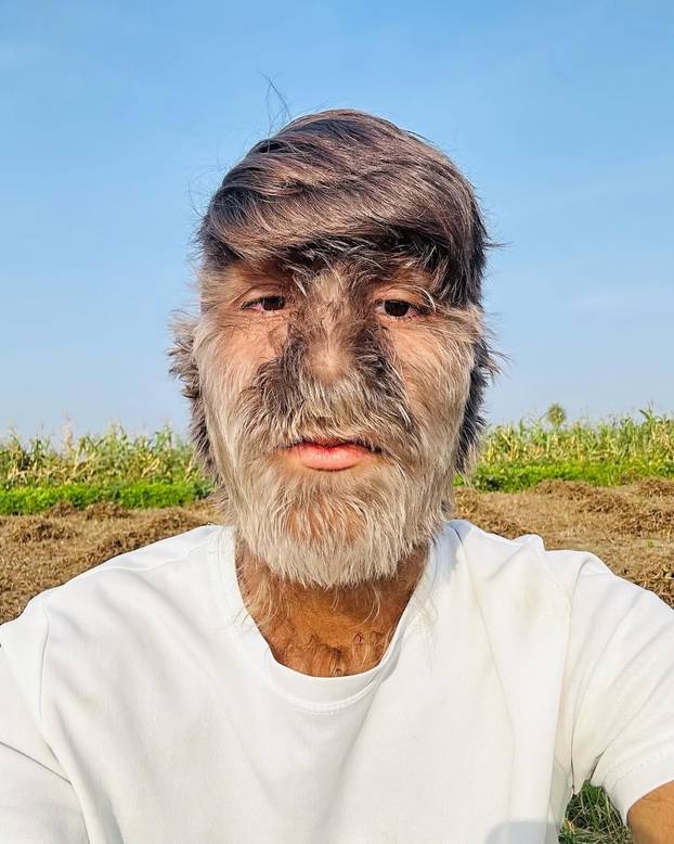 FOTO Ovaj mladić (18) pati od sindroma vukodlaka: U školi me sprdaju, ali volim svoje dlake...