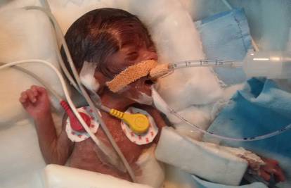 Beba heroj: Najmanji dječak na svijetu preživio operaciju srca