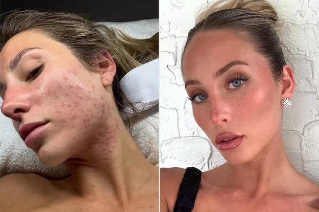 FOTO Pokazala nesavršenosti i zaludila internet: 'Želim da akne postanu seksi'