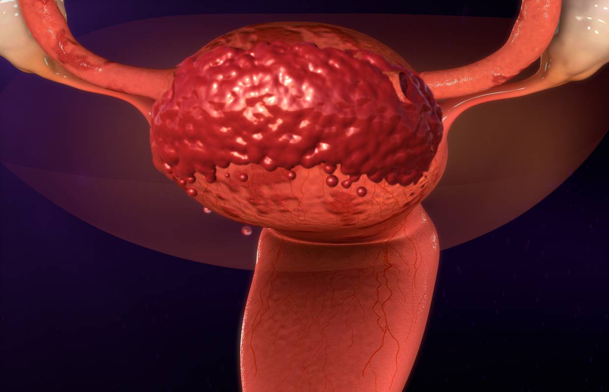 Kod visokih i vitkih cura veća vjerojatnost za endometriozu