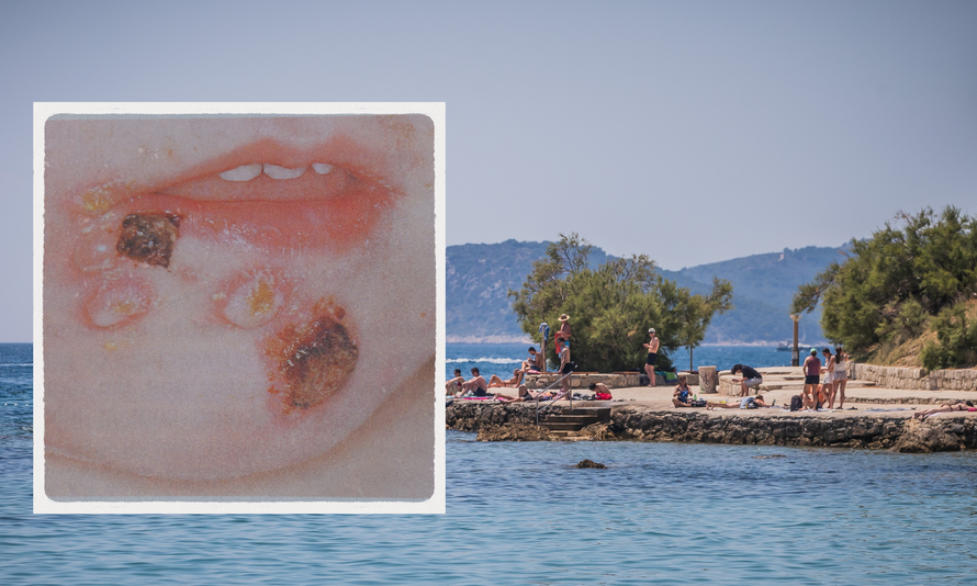 SPLITOM SE ŠIRI ZARAZA Djeca najugroženija, a od nje strahuju i turisti. Ambulante se pune...