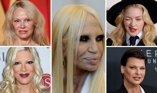 FOTO Bolno za gledati! Htjeli su se malo 'popeglati', ali botoks i operacije su im uni&scaron;tili izgled...