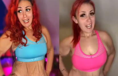Pokazala kako joj izgleda tijelo nakon što je izgubila više od 100 kg: Ne mora vam se sviđati