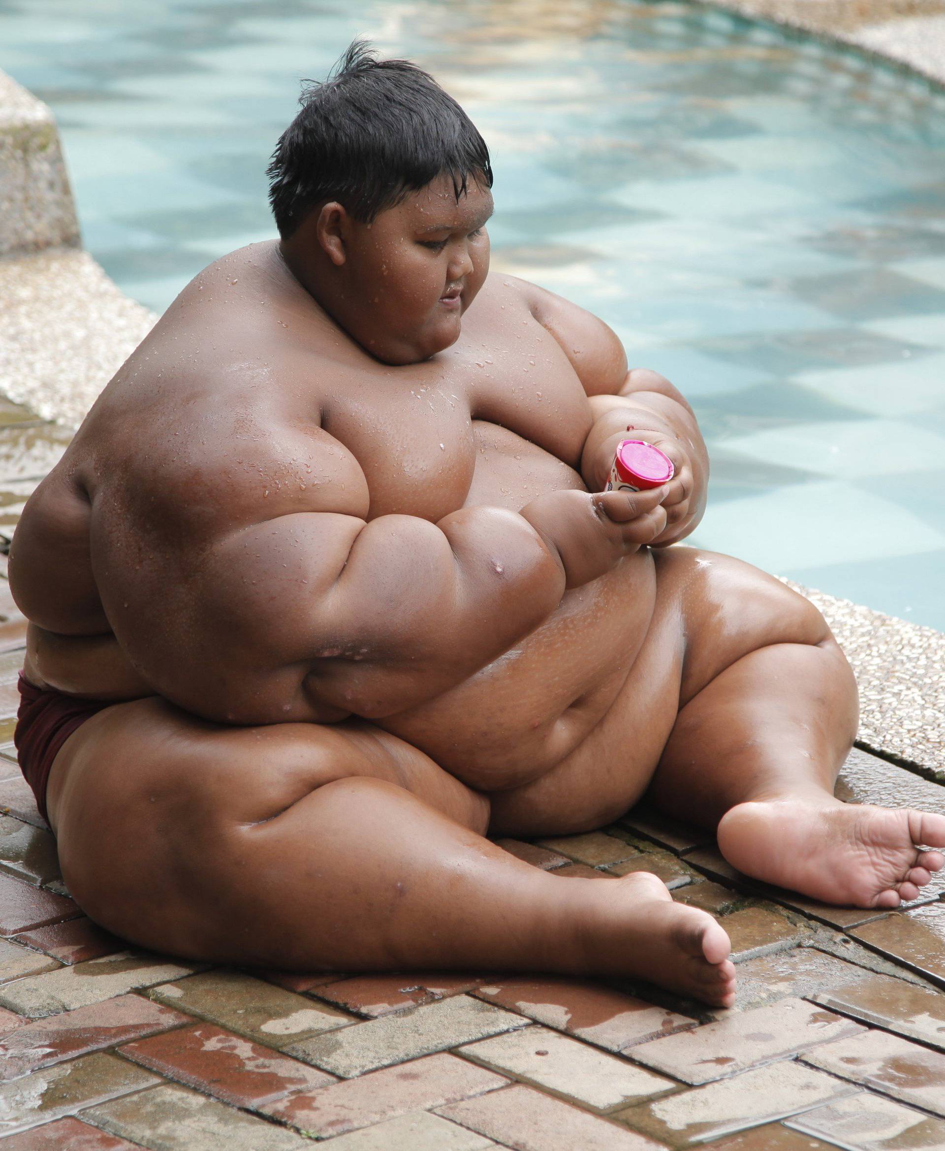 World's Heaviest Child Has Weight Loss Surgery