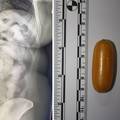 Ovo je rendgen Brazilke koja je u Zagrebu pala s kilu kokaina: Progutala 76 kapsula s drogom