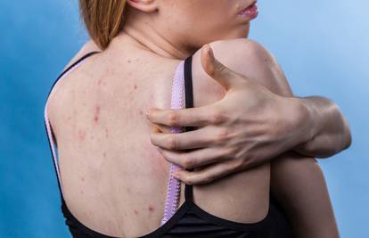 4 načina kako spriječiti pojavu akni i tamnih mrlja na leđima