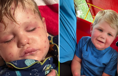 Užas u Americi: Dječaka 150 puta ubole ose, koža mu je požutjela, a organi otkazuju