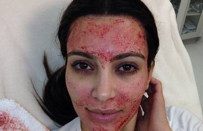 Kim se rješava bora: Liječnici su joj u lice uštrcali vlastitu krv