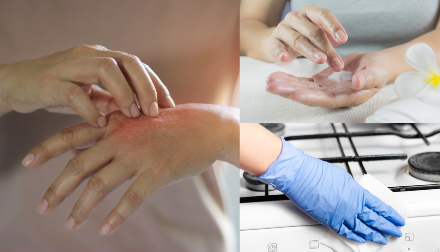 Ekcem na rukama: Što je uzrok te kako ga umanjiti i njegovati