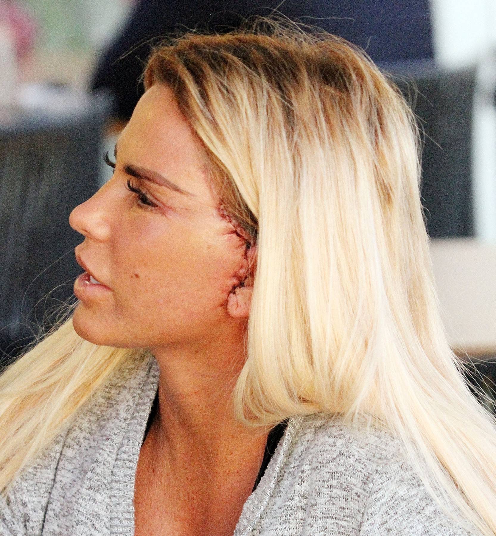 *PREMIUM-EXCLUSIVE* MUST CALL FOR PRICING BEFORE USAGE  - The British Glamour Model Katie Price aka Jordan is in recovery mode showing the scars from the results of her facial procedure out in Turkey