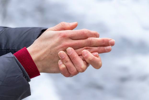 Women's,Hands,With,Dry,Skin,And,Red,Fingers,In,The