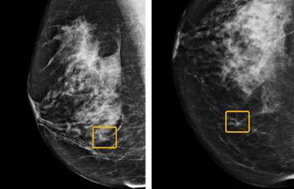 Novi program bolji u dijagnozi raka dojke od samih radiologa