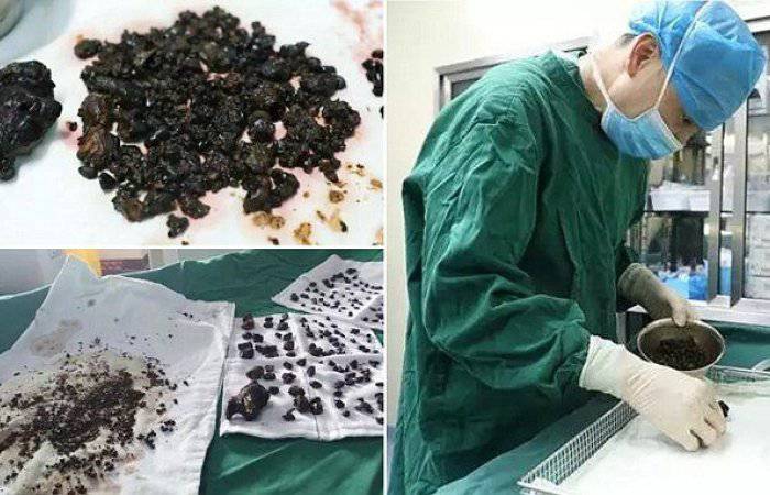 Liječnici u šoku: Ženi iz tijela izvukli više od 200 kamenčića