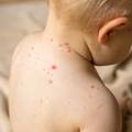 Pedijatar Jovančević: Vodene kozice čak i kod djece mogu biti opasne, razmislite o cjepivu
