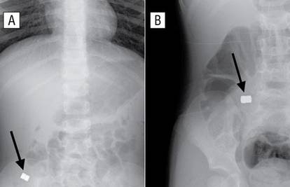 U crijevima dječaka (4) na rendgenu našli magnete