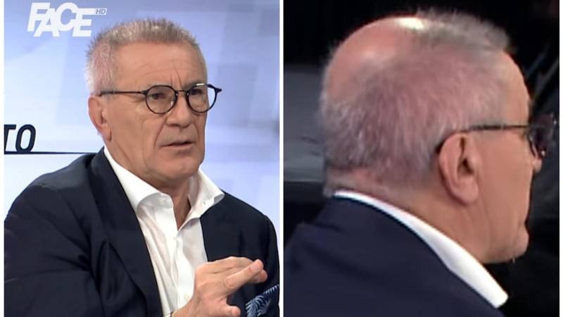 'Zdravko ježić': 'Bio na bolnoj transplantaciji kose i još se nije primilo na svim dijelovima'