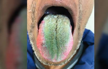 Doktori svašta vide: Muškarcu izraslo zeleno krzno na jeziku!
