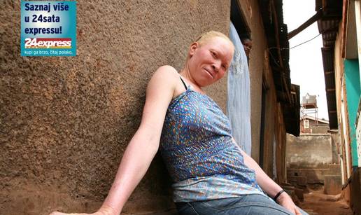 Albino ljudi iz Ugande: Ubijaju nas i komadaju zbog sre&cacute;e...